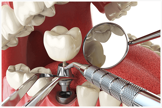 dental implants port melbourne