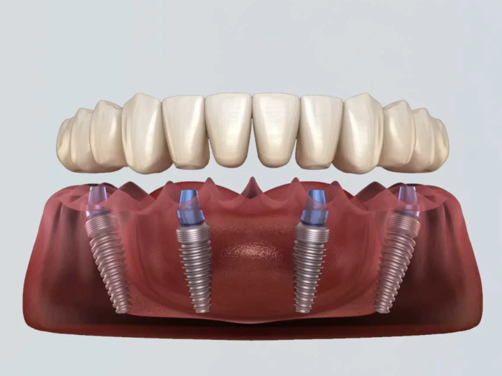 The Full Mouth Reset — Why All-on-4 Is Trending Among Adults