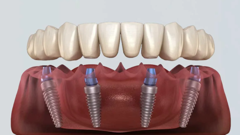 The Full Mouth Reset — Why All-on-4 Is Trending Among Adults