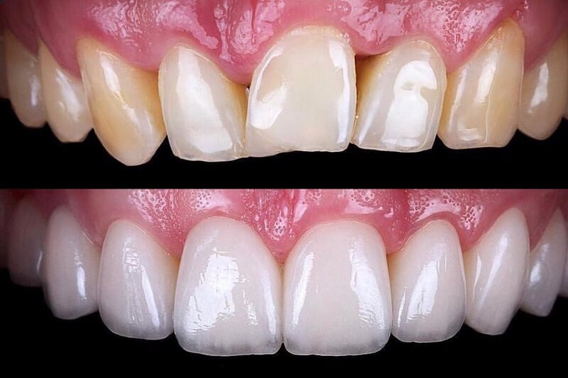 dental-veneers