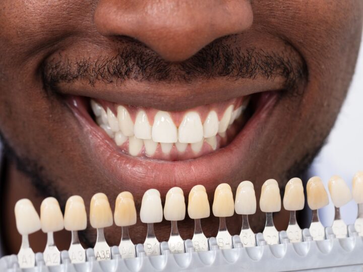 Snap On Smile vs. Veneers: Which One Is Actually Worth It?