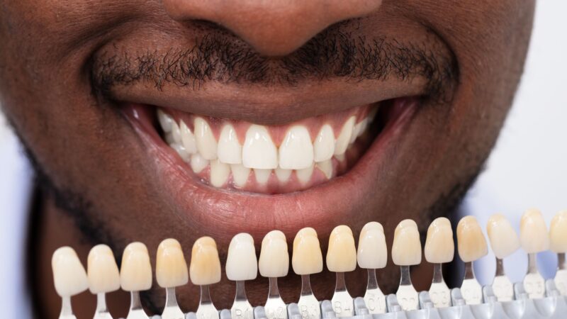 Snap On Smile vs. Veneers: Which One Is Actually Worth It?