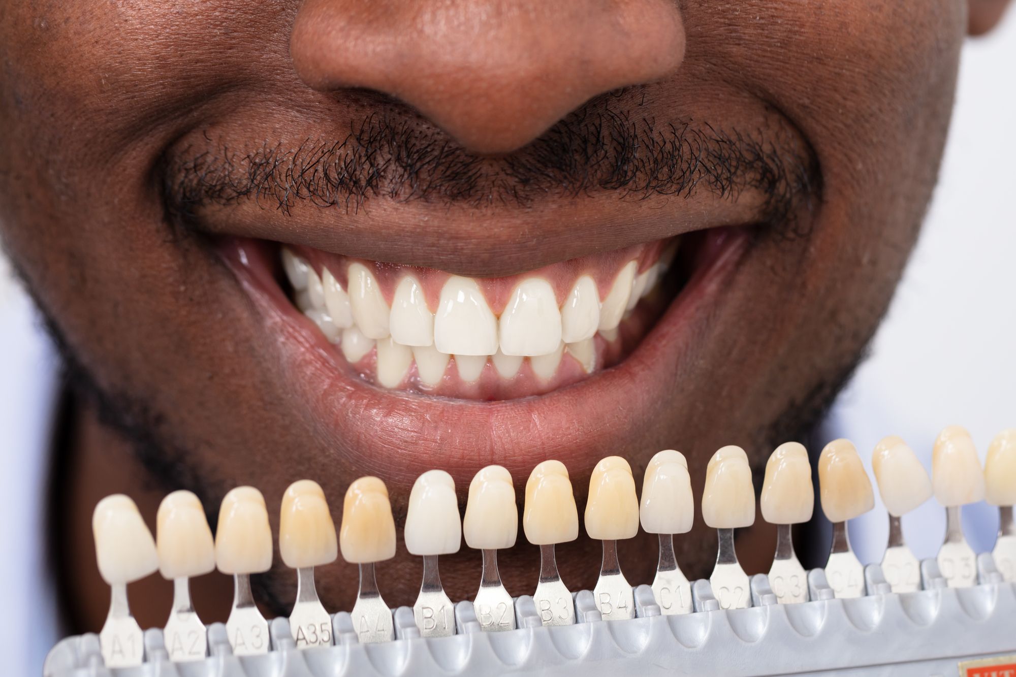 Snap On Smile vs. Veneers: Which One Is Actually Worth It?