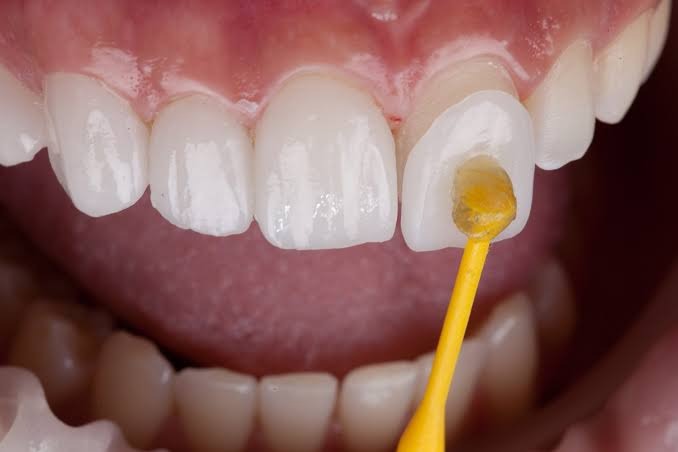 Veneers in Encino